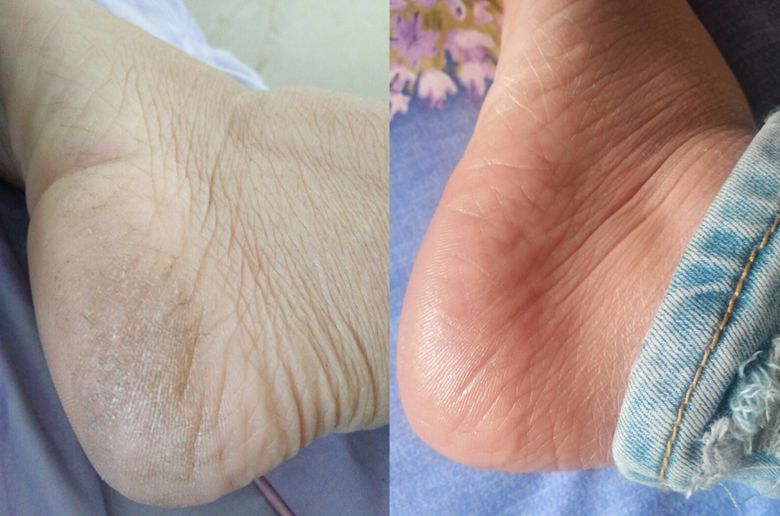 冬天脚跟干裂又起皮怎么办,冬天脚跟干裂起硬皮擦什么保湿好