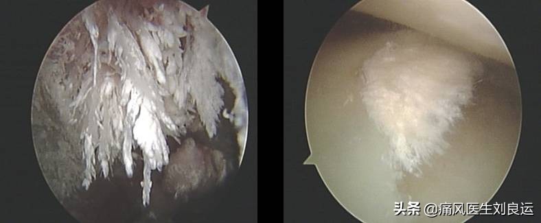 降尿酸祛痛风最健康的方法,降尿酸治痛风的最好方法