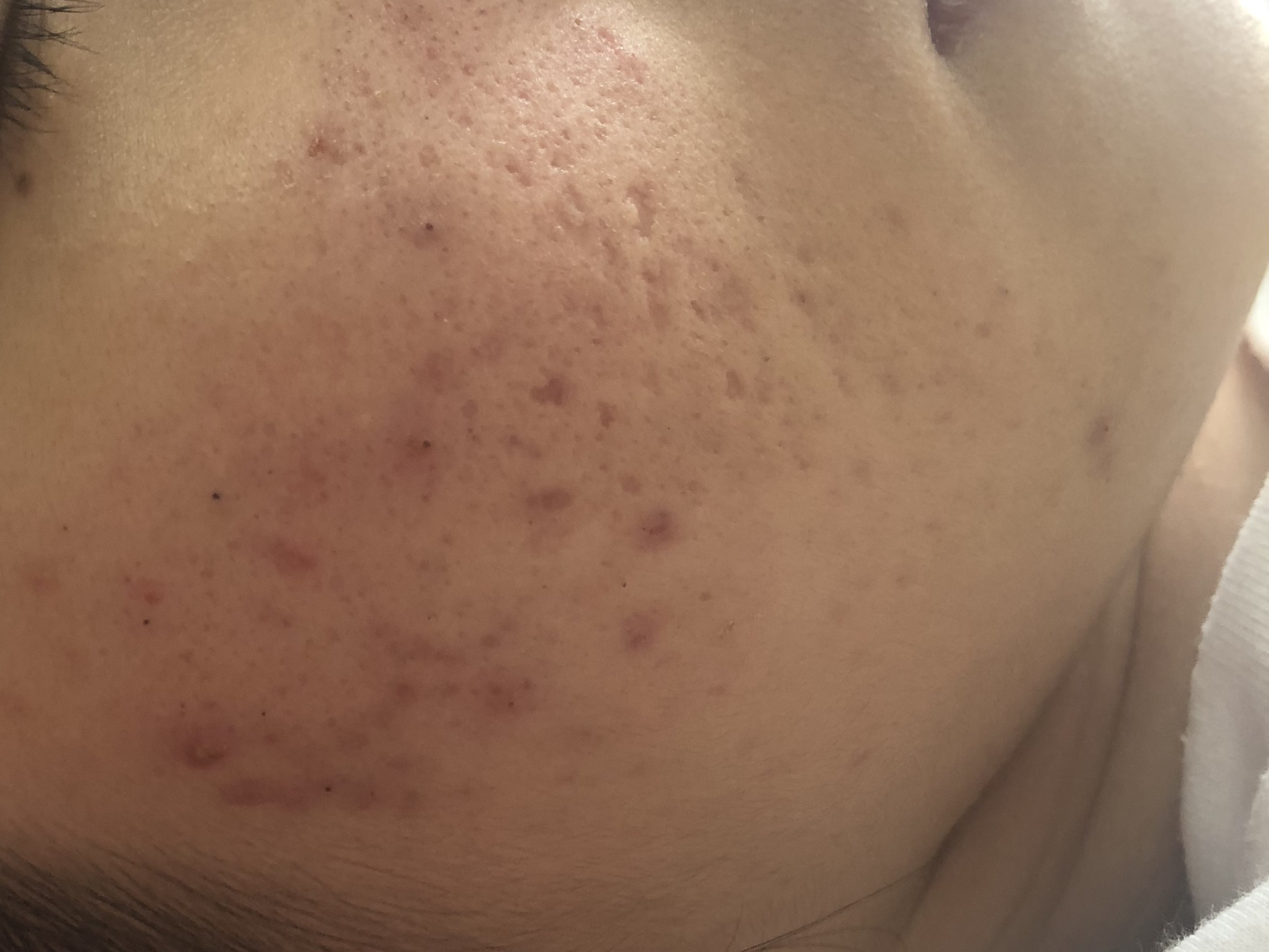 17岁的孩子身上脸上长了好多痘痘,17岁女孩脸上长好多痘痘怎么办