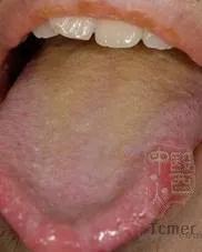 黄苔怎么造成的,黄苔一定是实热吗