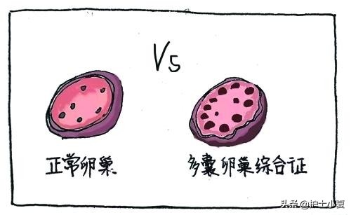 多囊卵巢综合征能怀孕不,多囊卵巢综合征能正常怀孕吗