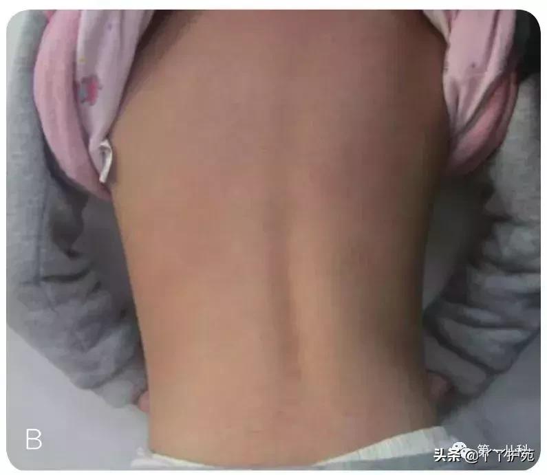 麻疹水痘猩红热手足口病区别,猩红热手足口病怎么治