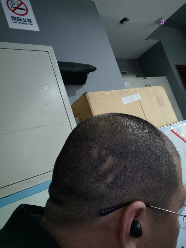 发现斑秃刚好又开始掉头发怎么办,突然发现斑秃怎么治疗