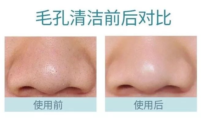 清理黑头最好用的办法,去黑头的最好方法不用清洁