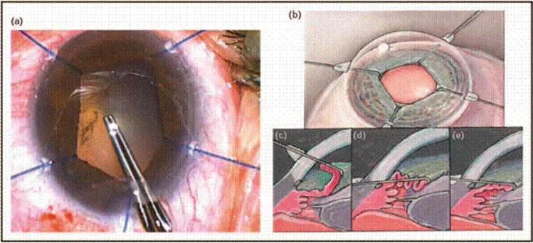 小瞳孔白内障的治疗,瞳孔小能做白内障手术吗