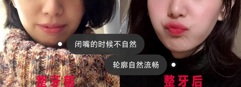 整牙过程超治愈,整牙全过程解说