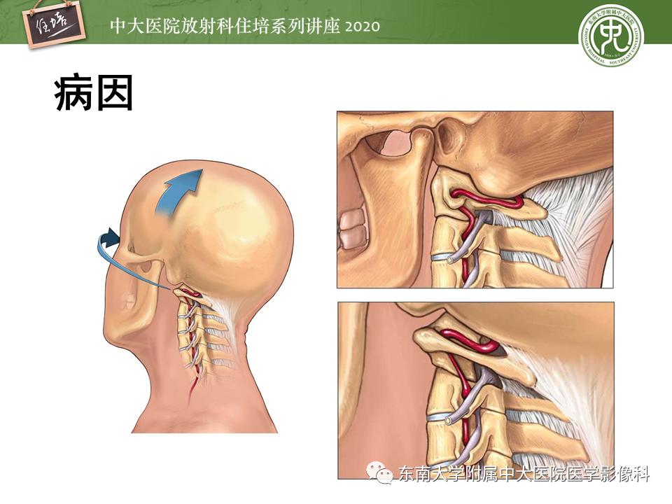 颈动脉夹层的超声表现及漏诊分析,动脉夹层与夹层动脉瘤是一样的吗
