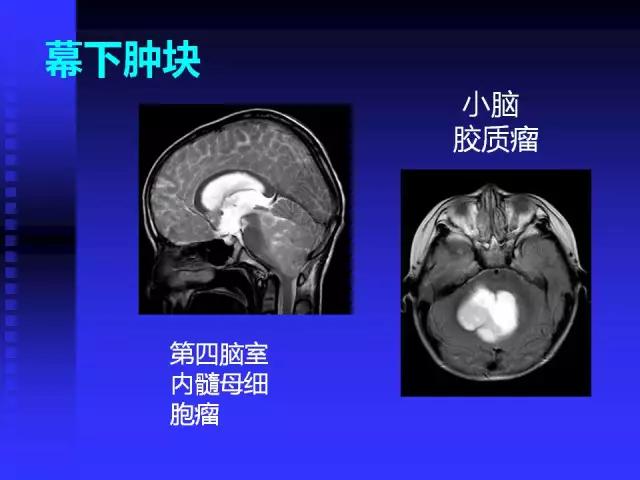 头颅mri读片视频教程,颅脑mri读片入门教程视频讲解全集