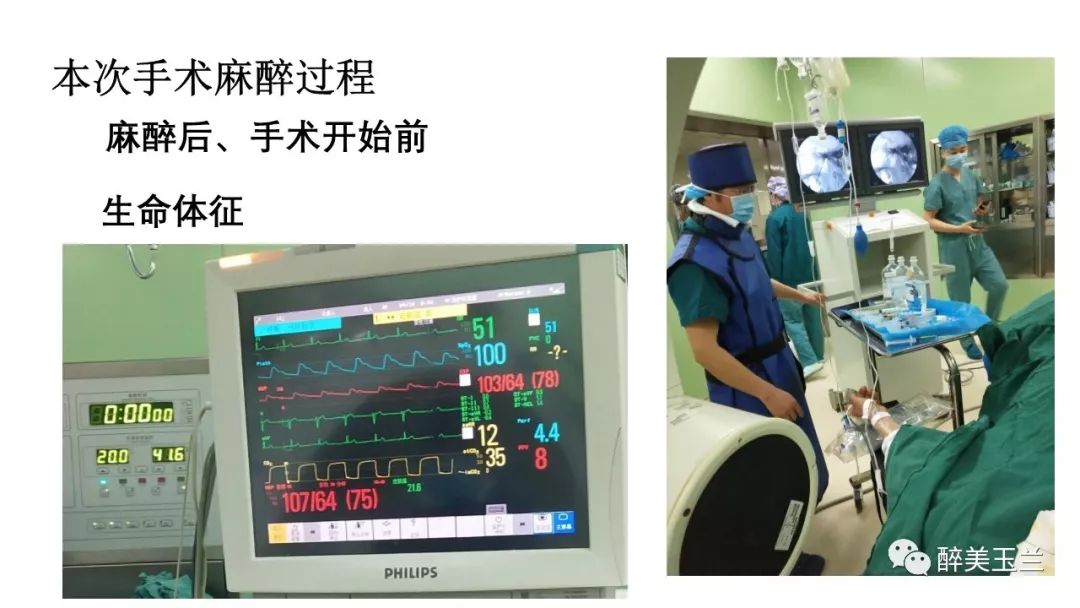 病例分享丨三叉神经节微球囊压迫术的麻醉管理