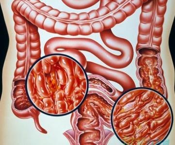 肠道上长溃疡是怎么回事,肠道上有溃疡能自愈吗