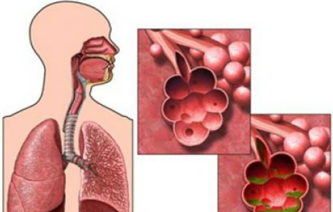 中国院士袁隆平曾患过慢阻肺吗,钟南山院士谈慢阻肺的治疗方法