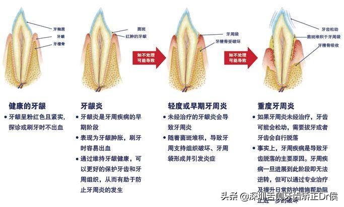 睡觉牙龈总是出血吃什么药,一颗牙齿牙龈总是出血