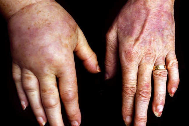 手指肿胀要警惕三种病,手指肿胀是10种疾病的警示信号