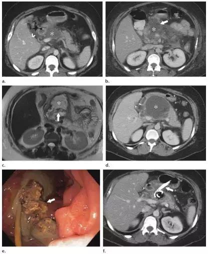 急性胰腺炎影像检查首选,急性坏死胰腺炎影像