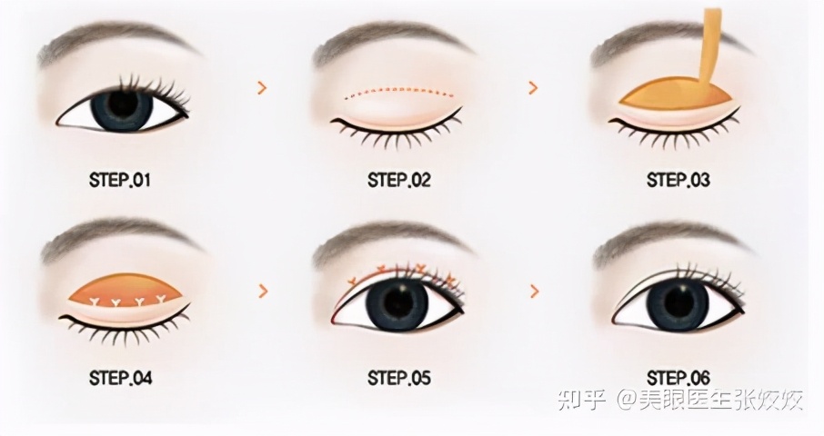 内双的人割双眼皮会更自然吗,怎么把内双变双眼皮的自然方法