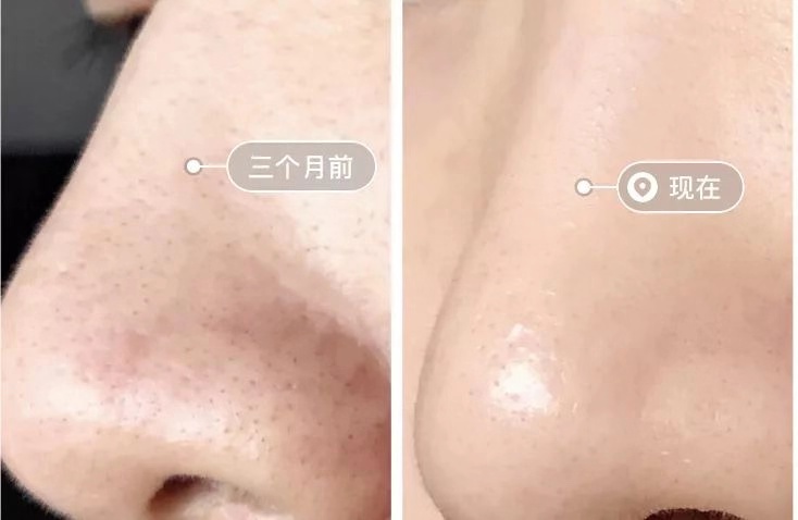 一秒去黑头去粉刺,一步就能搞定的黑头