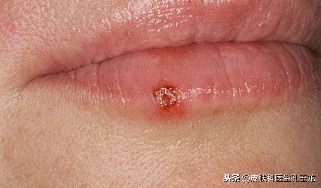 嘴唇长疱疹是哪里上火了,嘴唇上火起泡和单纯疱疹怎么区别