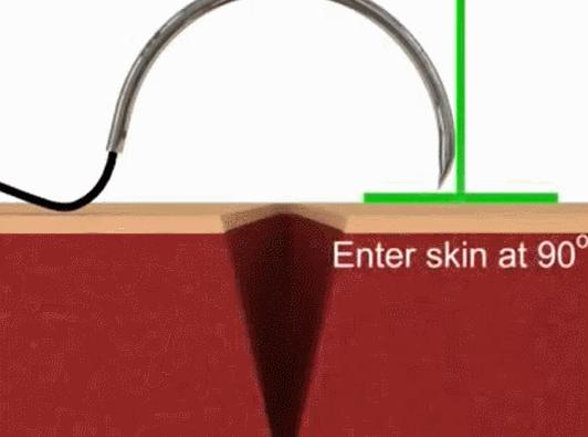 常用的手术缝合方法图,临床常见常用伤口缝合方法