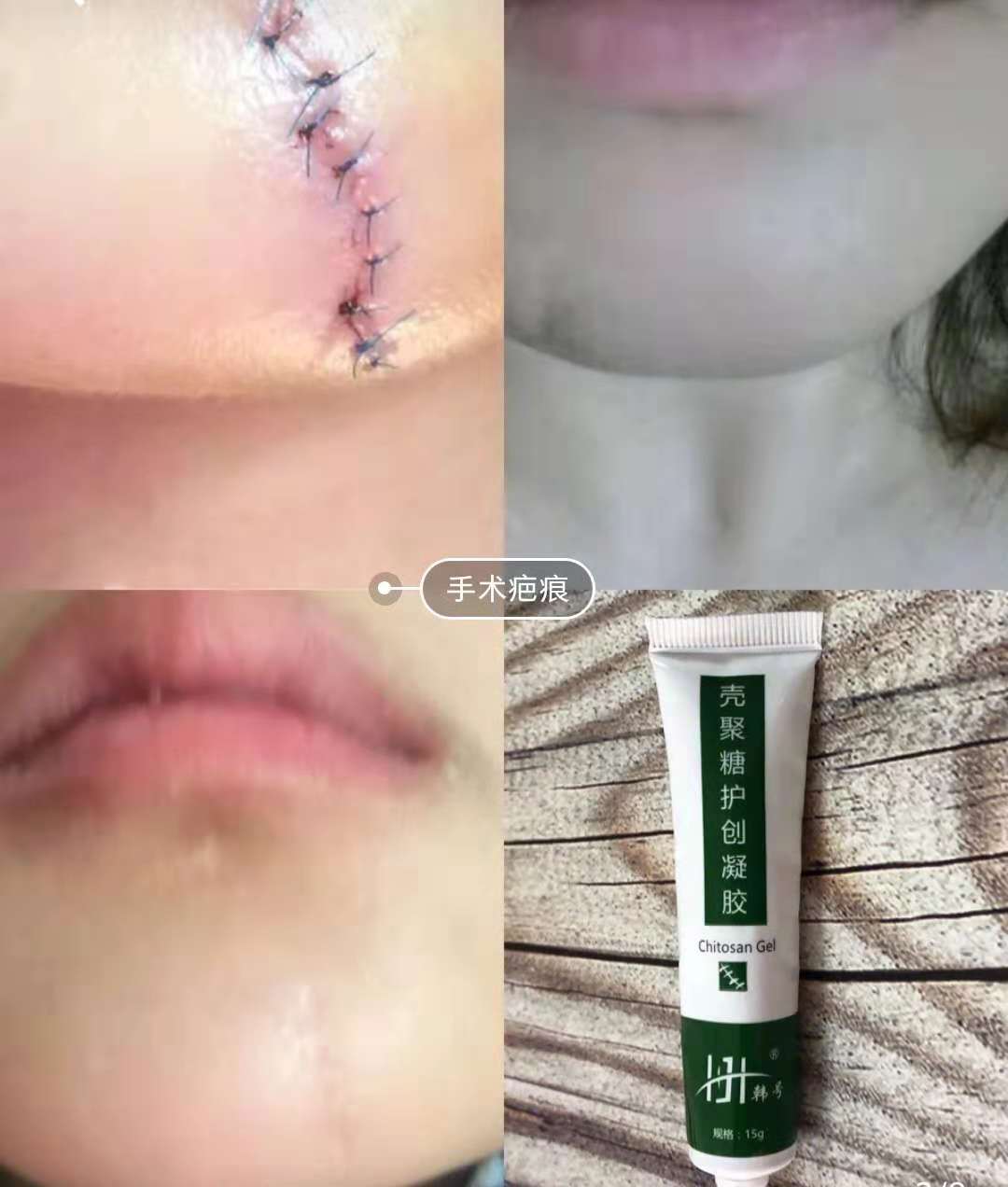 妊娠纹祛疤痕5年了最好的方法,去妊娠纹产后修复排行榜