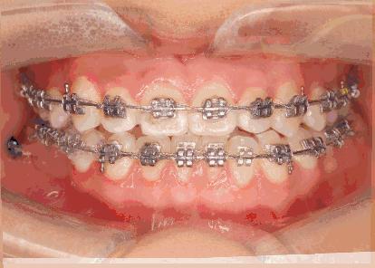 小伙相亲被弃，“大凸牙，我不要嫁给你”快三十，矫正还来得及？