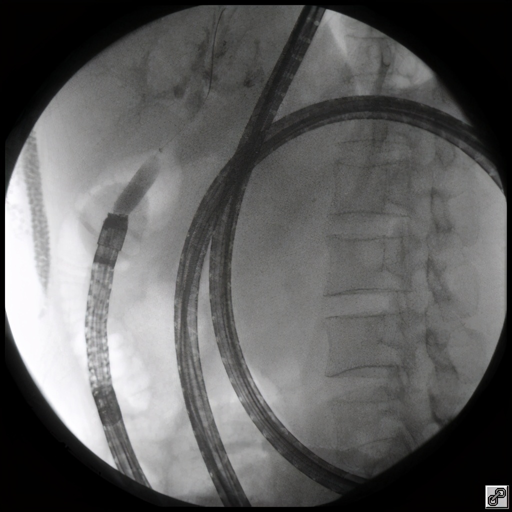 八年胆汁流通不畅，老奶奶成了“小黄人”……