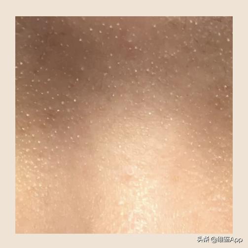 挤痘一定要挤出血吗,徒手挤了痘痘怎么办