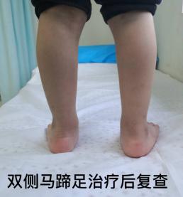 马蹄内翻足孩子的康复,成人马蹄足内翻康复治疗