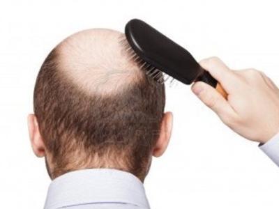 第一批秃头的90后,第一批90后开始秃头