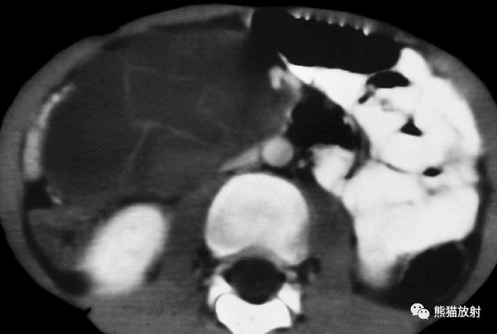 肠系膜解剖图,肠系膜解剖图解