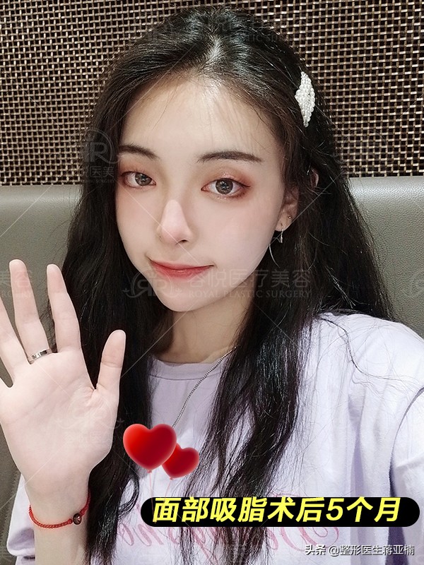 面部吸脂后如何快速消肿,面部吸脂去哪做