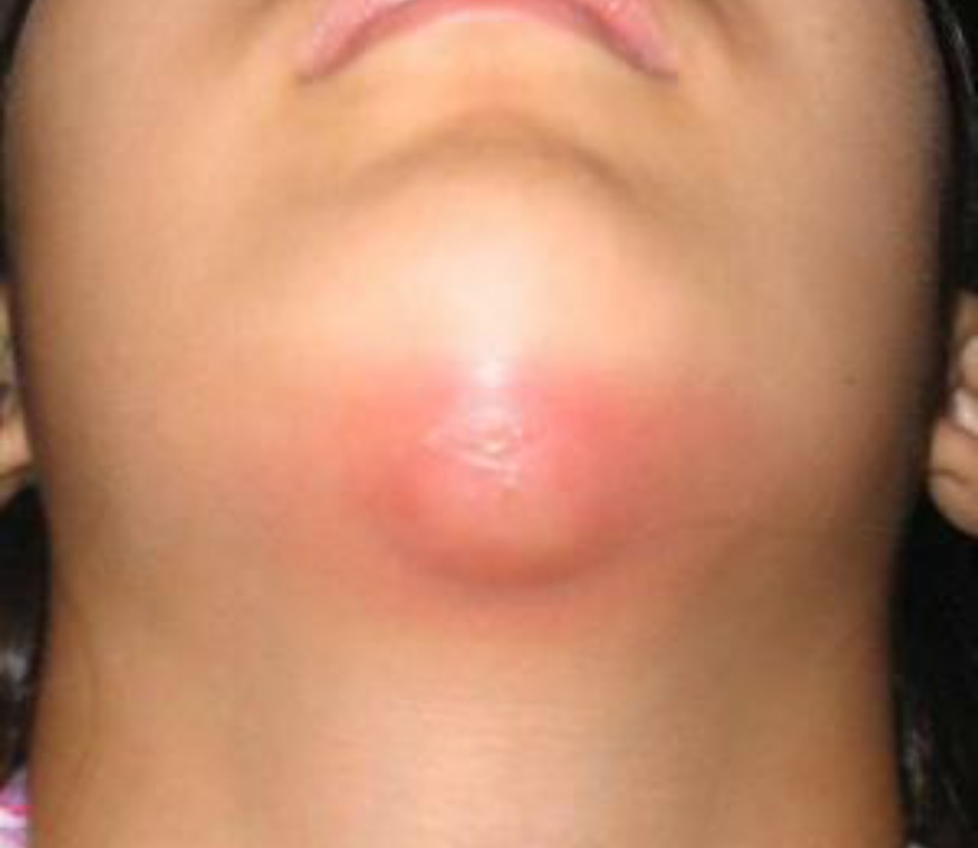 体表漫状血管瘤是罕见病，患者体表多肿块，请及时检查治疗