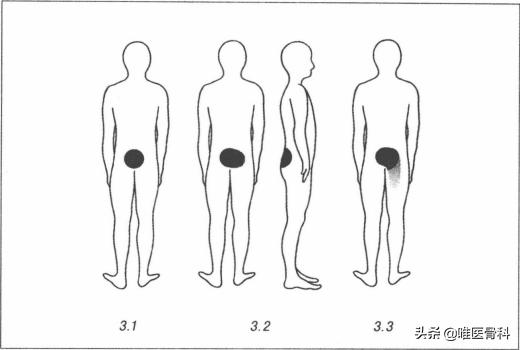 腰椎间盘突出手术后多久可以跑步,患了腰椎间盘突出还能跑步吗