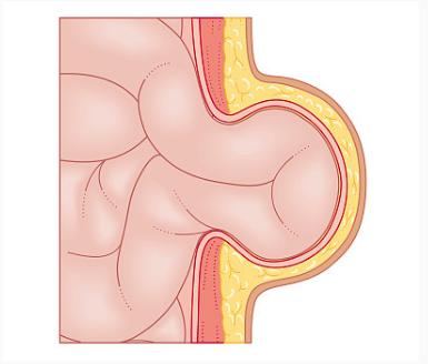 小疝气最简单的消除方法,疝气鼓包在家治疗的好方法
