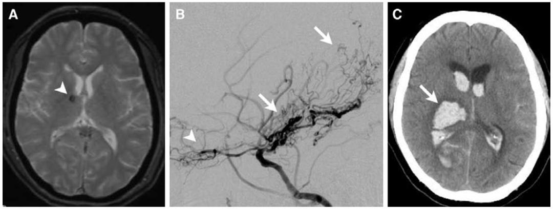 头疼做磁共振脑小血管有点出血,核磁共振说脑血管出血