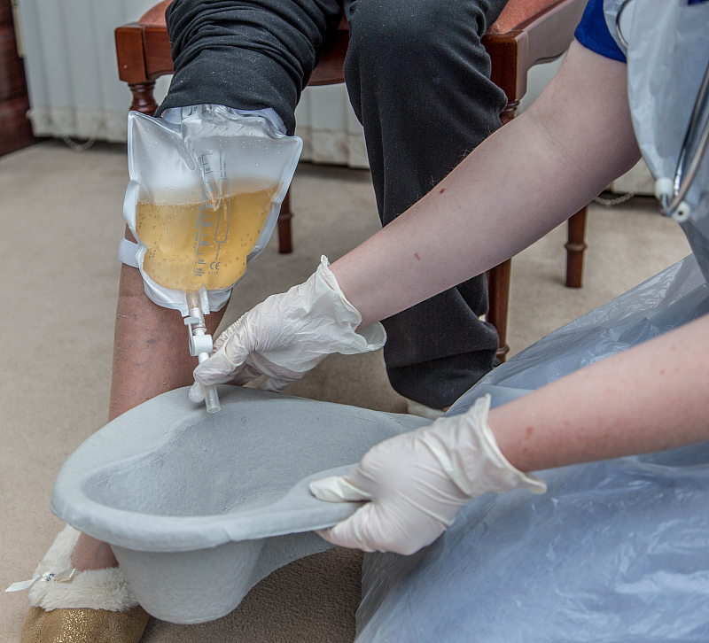 为什么要导尿插管,导尿时可自己拔管吗