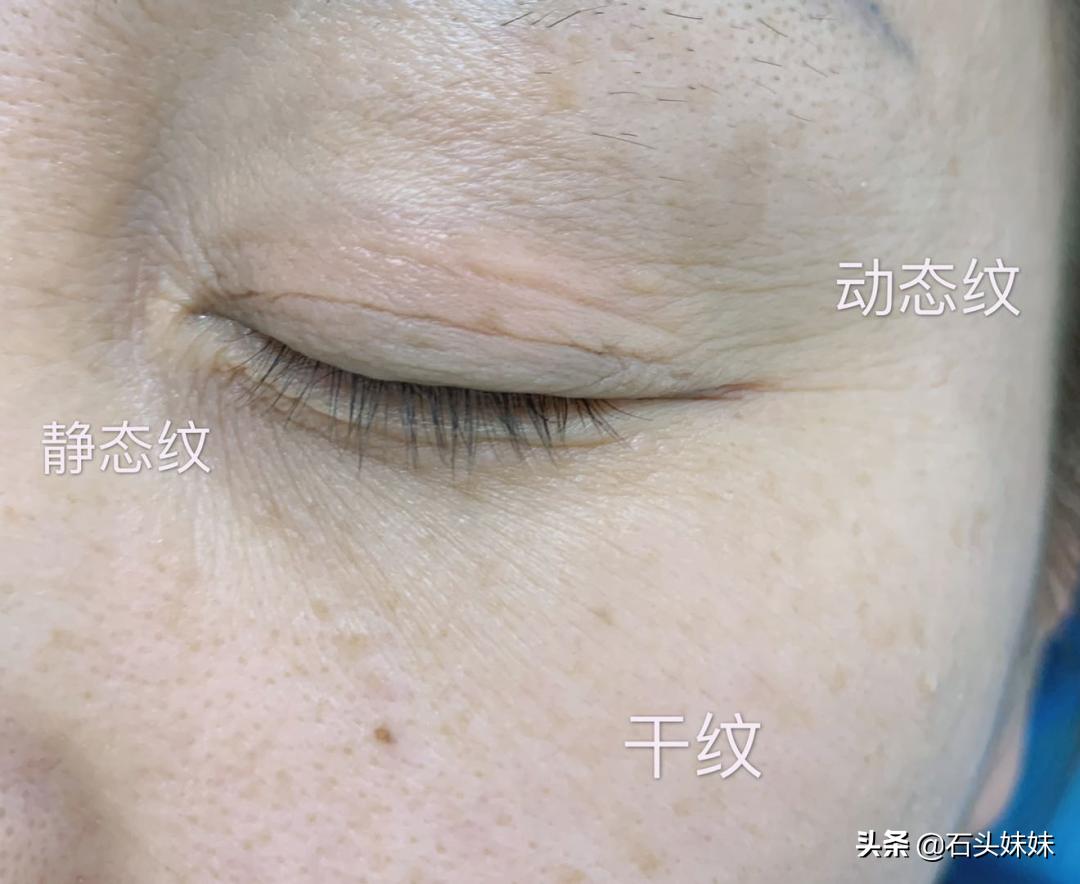 怎么遮眼纹和黑眼圈,黑眼圈眼纹很重显老怎么办