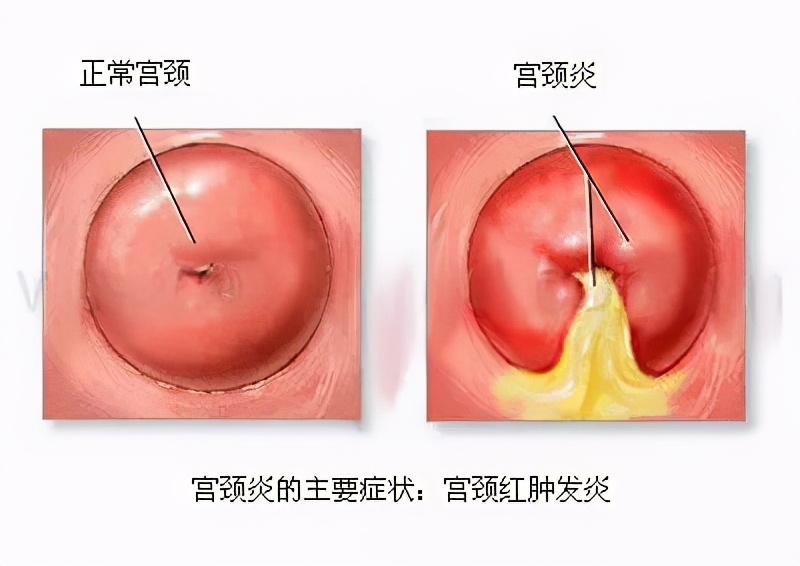 白带异味宫颈糜烂,白带有异味宫颈口有点瘙痒