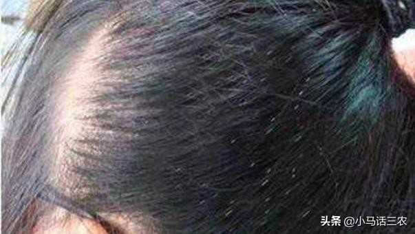 农村人现在还长虱子吗,为什么以前农村的虱子现在少见了