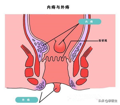 肛周脓肿和痔疮手术一起做的费用,痔疮和肛周脓肿术后在家怎么换药