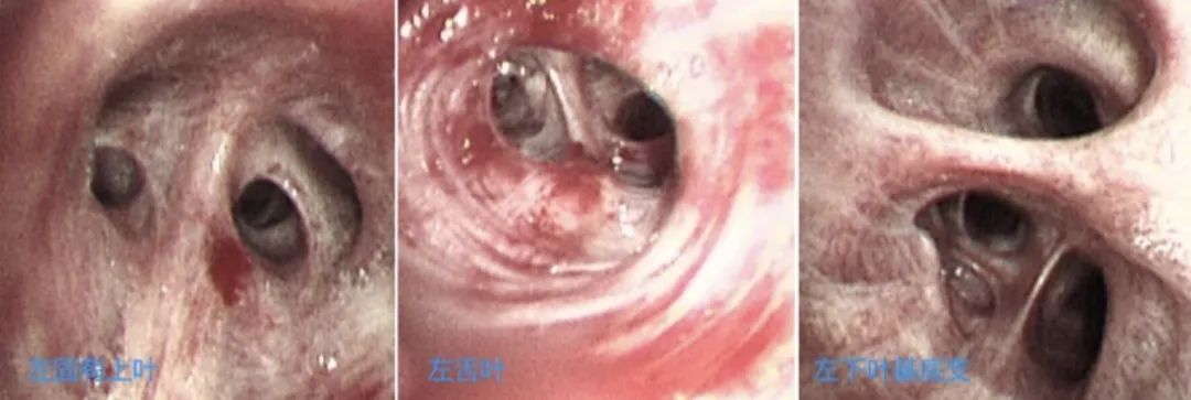 时隔一年再次住院,时隔一年旧病复发