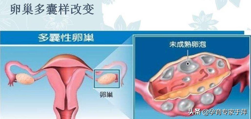于萍：大夫，B超检查卵巢多囊样变，这是多囊卵巢综合征吗？