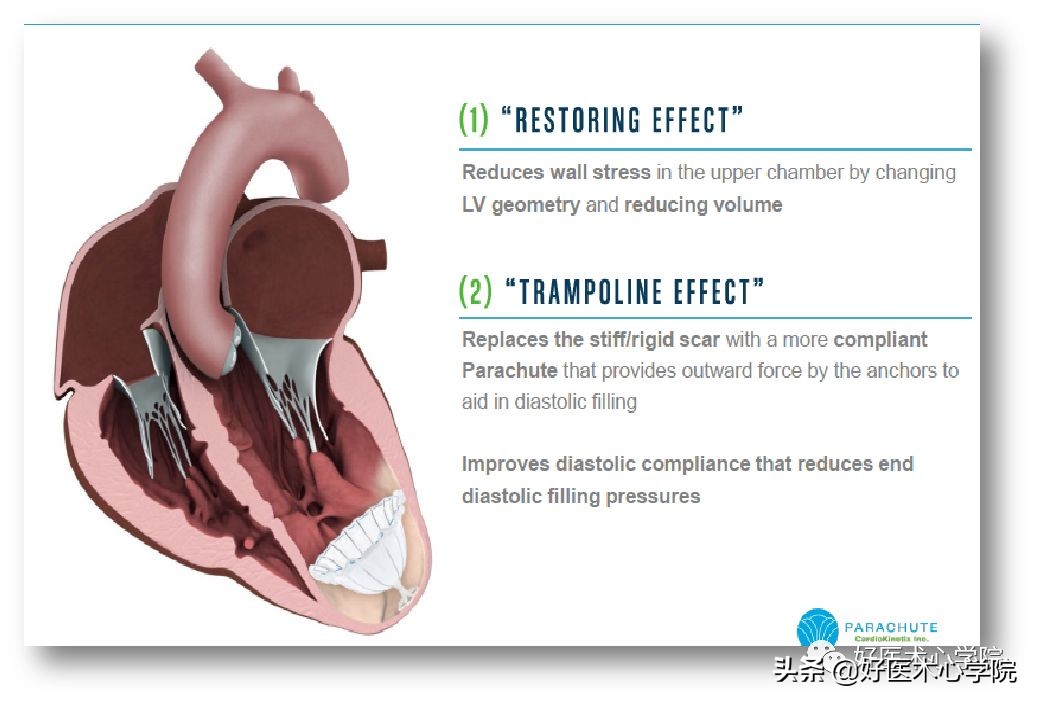安贞医院冠心病介入治疗新技术,冠心病介入术
