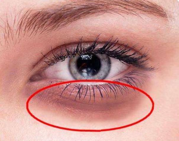 黑眼圈重有细纹怎样遮黑眼圈,有浓厚的黑眼圈该怎么淡化黑眼圈