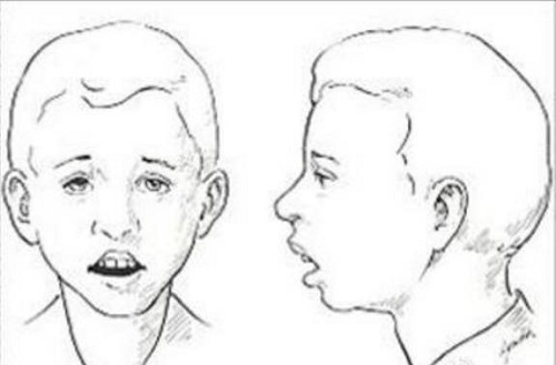 孩子打鼾别大意警惕腺样体肥大,孩子打鼾一定是腺样体肥大么