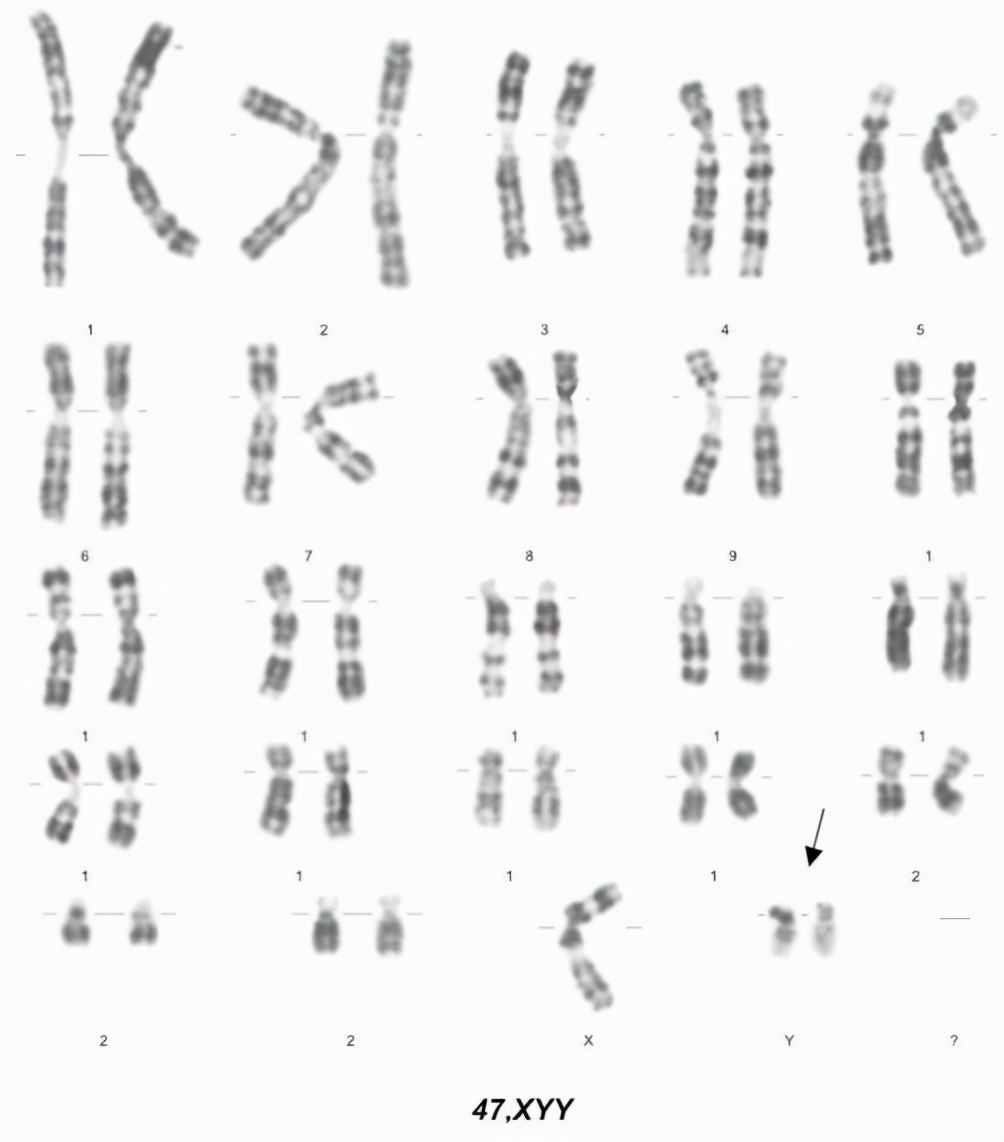 男性染色体多一条x能生育吗,有xyy染色体的人是男人吗