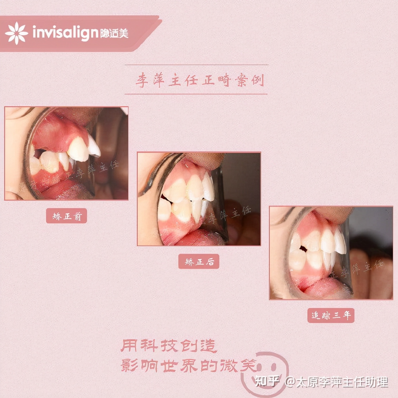 太原市牙齿正畸,太原市口腔正畸