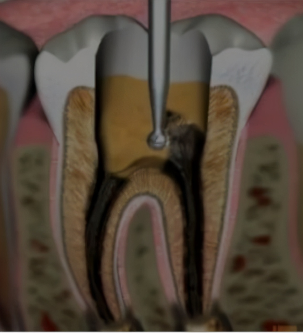 根管治疗封药后一碰疼痛,牙齿根管治疗封药后疼痛怎么办