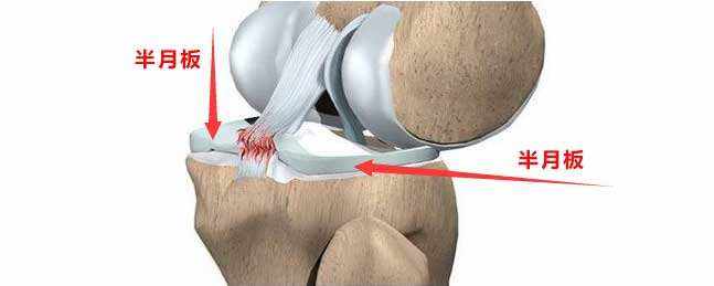 膝盖一弯曲就疼一招解决,膝盖走路一弯曲就疼怎么办