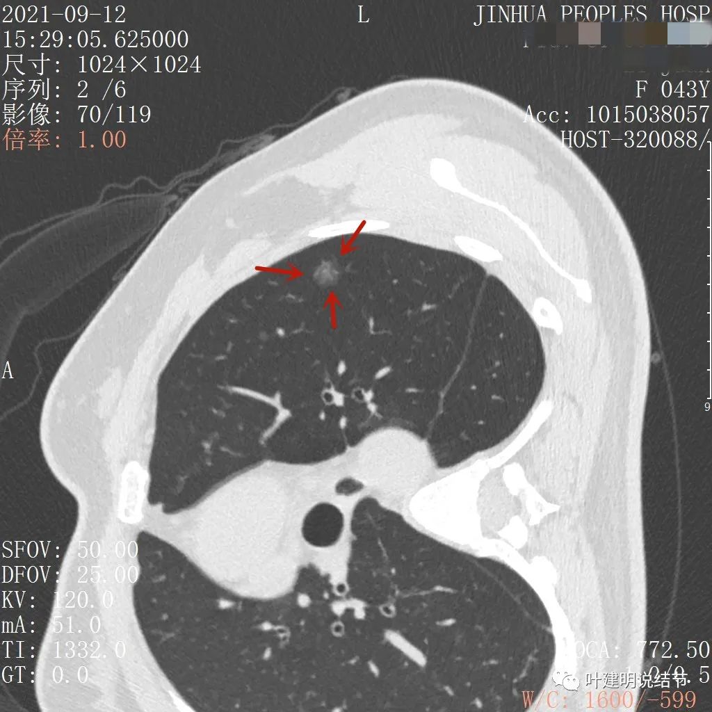 怎样从病理报告看是不是原位癌,原位腺癌切除子宫要开刀吗