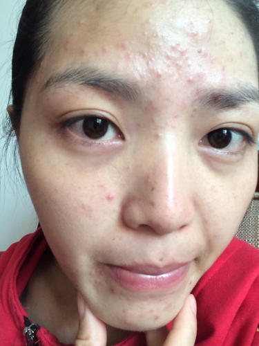 怎样有效消除脸上的痘痘,怎样去除脸上的痘痘和痘印